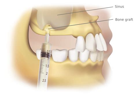 The Sinus Bone Graft