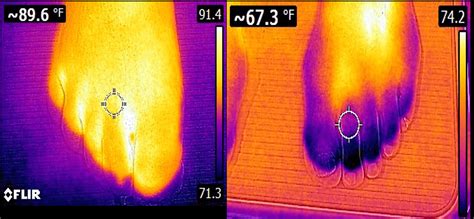 Thermal Imaging Neuropathy