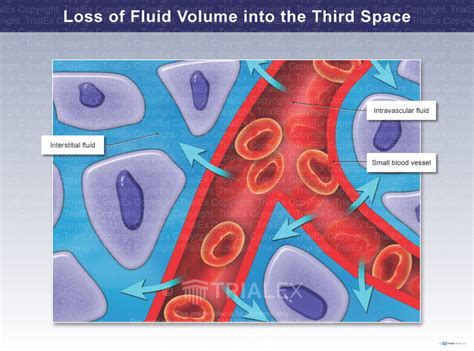 Third Spacing Fluid