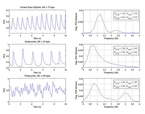 thomas hjorth parameters synonym