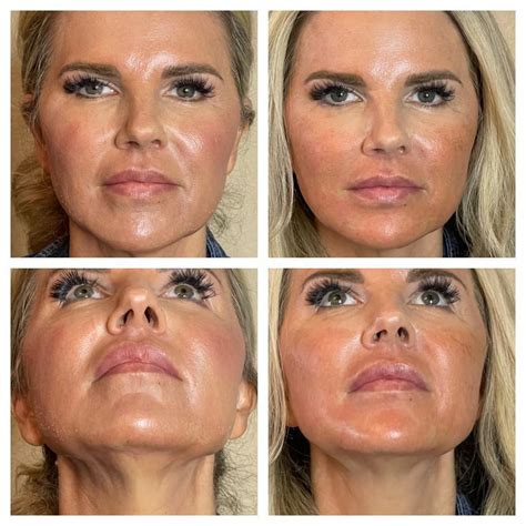 Threading Pdo Thread Lift Face Aesthetica Skin Centre