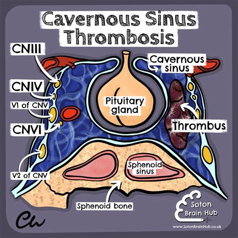 Thrombosis Sinus Cavernosus