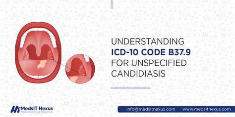 Thrush Icd 10