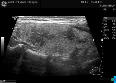 Thyreoiditis De Quervain