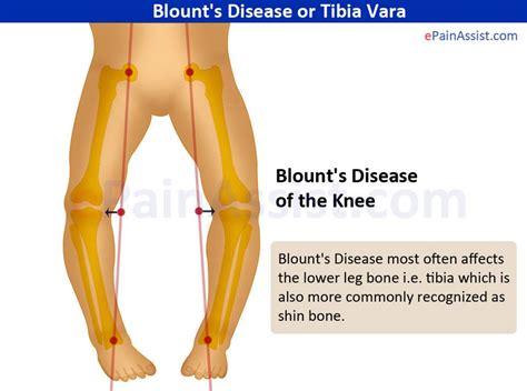 Tibia Vara Blount Disease