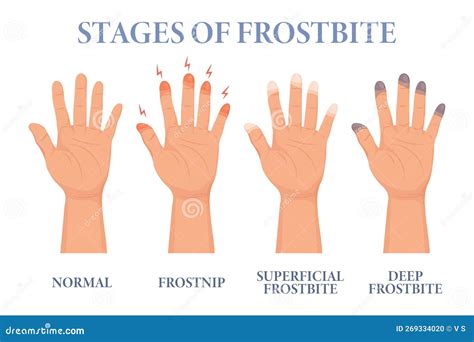 Time To Frostbite Chart