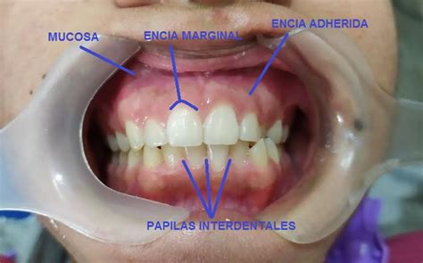 Tipos De Encia
