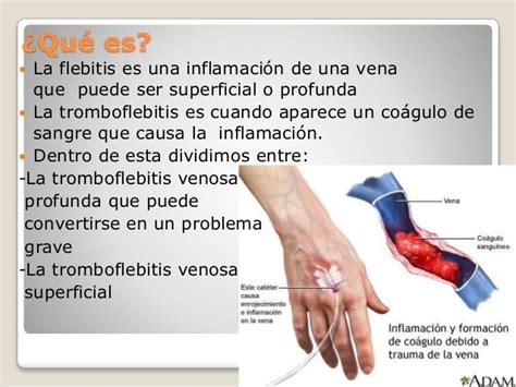 Tipos De Flebitis