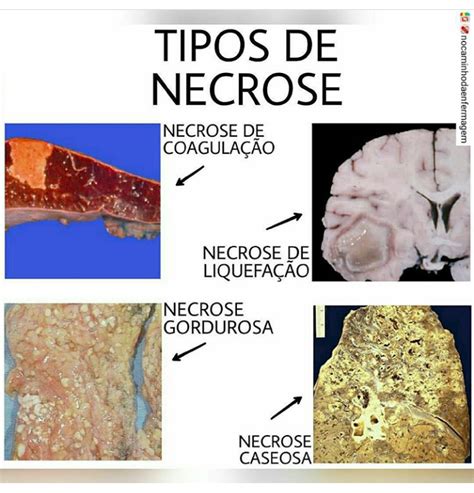 Tipos De Necroses
