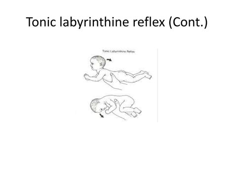 Tonic Labyrinthine Reflex