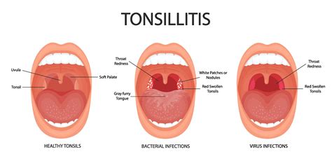 Tonsils Meaning In Marathi
