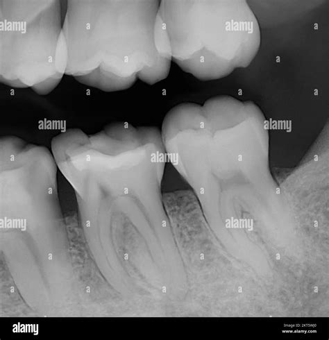 Tooth 13