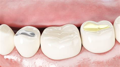 tooth colored fillings