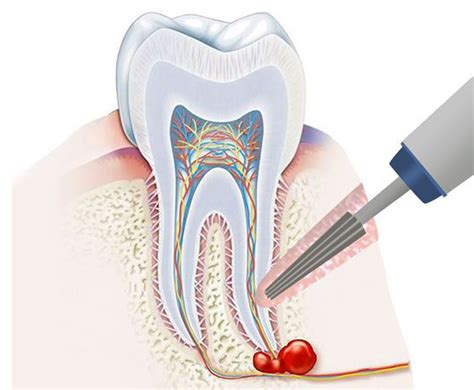 tooth extraction cyst - MedHelp