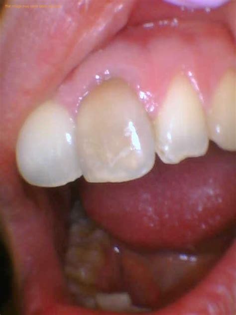 Read Online Tooth Bruise Manual Guide 
