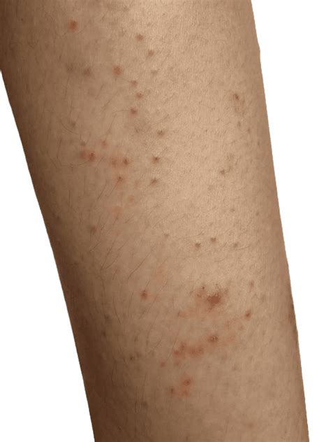 torr hud utslag barn