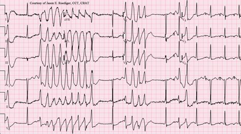 Torsades De Pointes