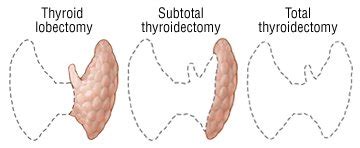 total thyroid