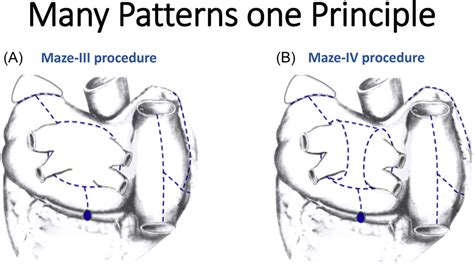 totally thoracoscopic maze procedure for the treatment of atrial ...