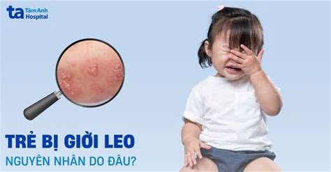 trị giời leo cấp tốc | Tr gii leo bng u xanh cc