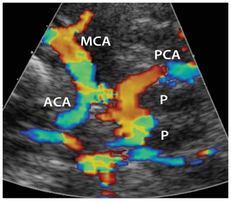 transcranial doppler sonography