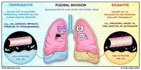 Transudate Vs Exudate