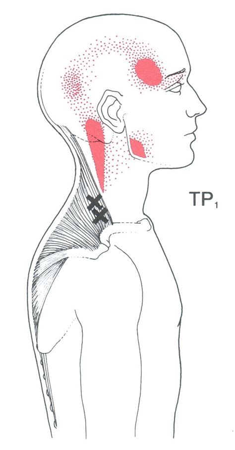 Trapezius Trigger Points