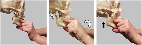 Read Online Treatment Of Recurrent Temporomandibular Joint Dislocation 