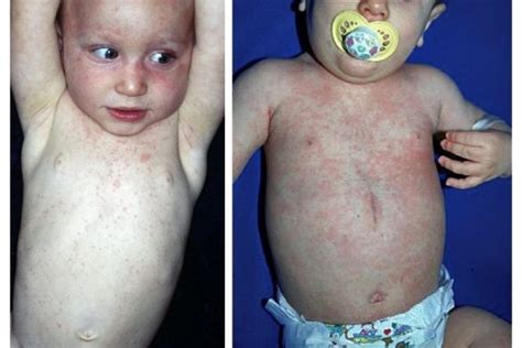 tredagarsfeber utslag ansikte