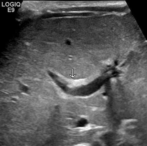 Triangular Cord Sign