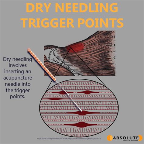 Trigger Point Dry Needling An Evidence And Clinical Based Approach 1e 1st First By Dommerholt Pt Dpt Faapm Jan Fernandez De Las Penas Pt Do 2013 Hardcover