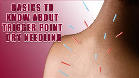 Download Trigger Point Dry Needling Static1 Squarespace 