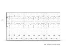 triggered AAT, VVT, DDT modes Cardiocases