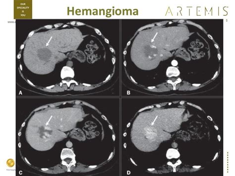 Triphasic Ct Scan