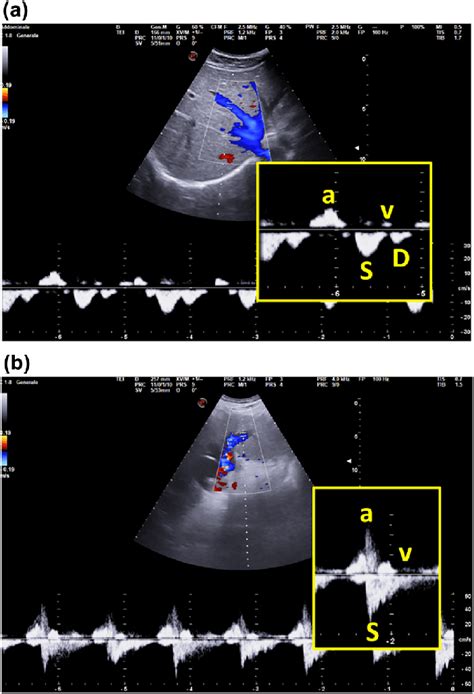 Triphasic Flow Doppler Liver