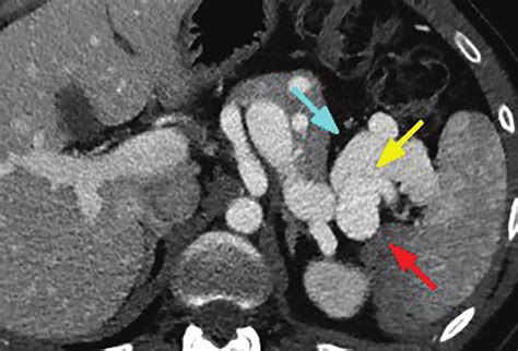 Triple Phase Ct Abdomen