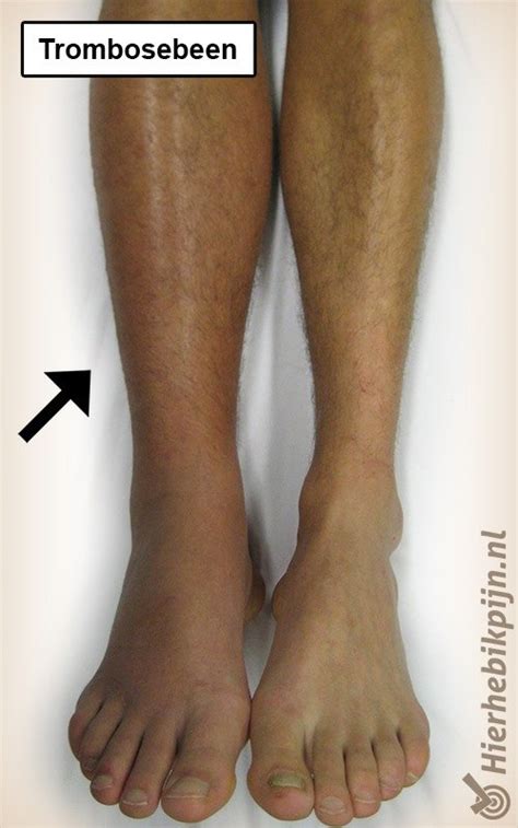trombose symptomen