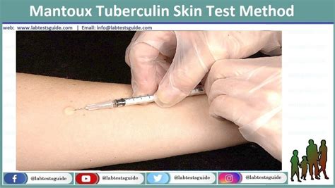 Tuberculin Sensitivity Test