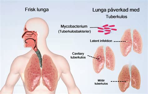 tuberkulos inkubationstid