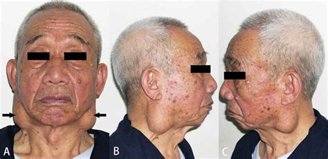 Tumor De Warthin