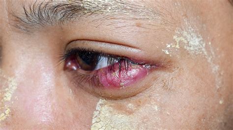tumor kelopak mata