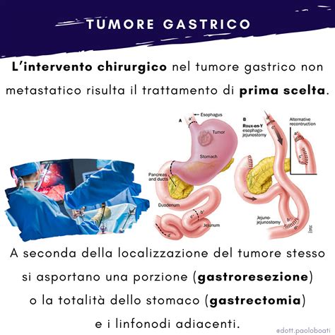 Read Online Tumore Dello Stomaco Tutte Le Domande Tutte Le Risposte 