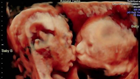 Twin Baby In Uterus