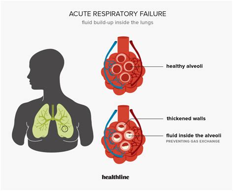 Type 2 Respiratory Failure