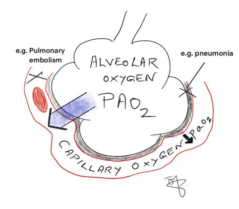 Type One Respiratory Failure