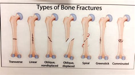 Types Of Bone Fractures Quiz Types Of Bone Fractures Worksheet - Types Of Bone Fractures Worksheet