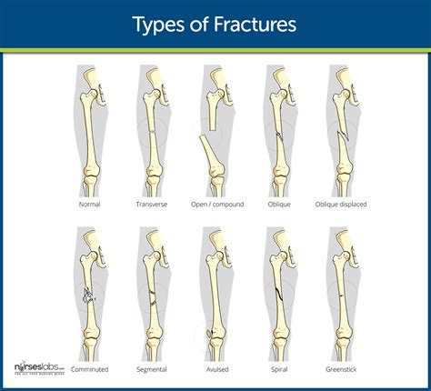 Types Of Fractures Pdf