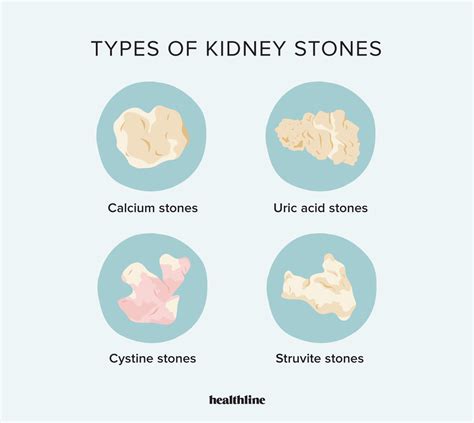 Types Of Kidney Stones