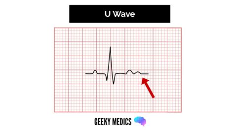 U Waves Ecg