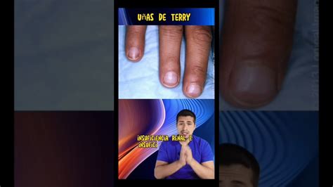 Uñas De Terry